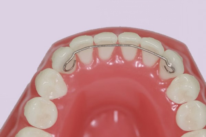 close up of bonded retainer on purple background