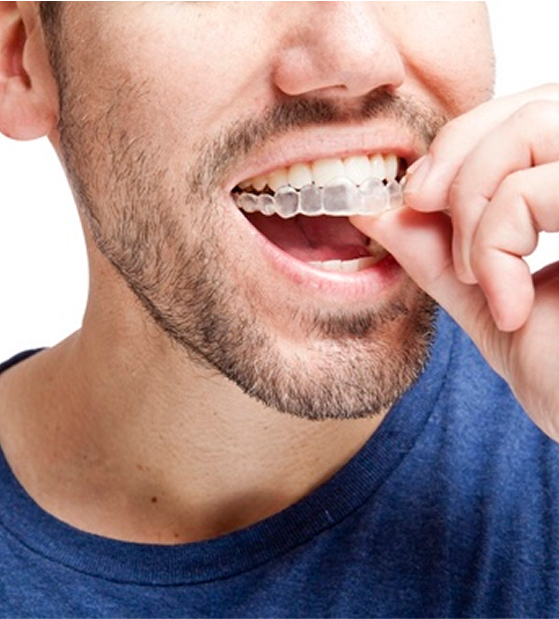 Close up of man inserting invisalign aligner