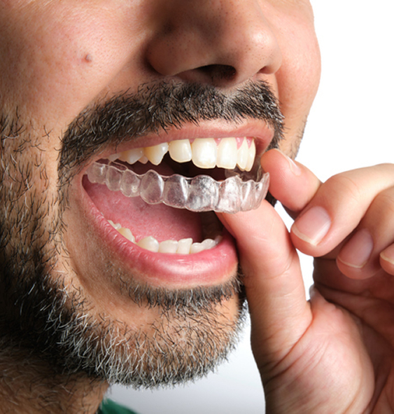 Close up of a man with a trimmed salt and pepper beard putting his Invisalign® aligner in