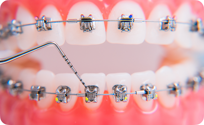 Close up of a dental model with multi-colored brackets attached being tightened by a small tool