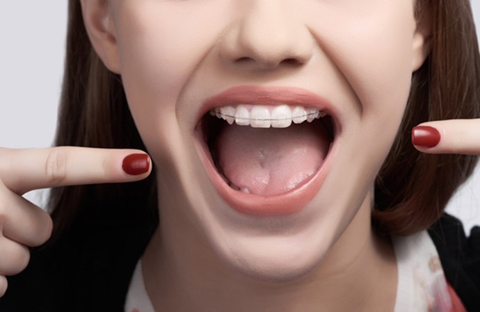 Close up of a woman with clear braces smiling and pointing to her mouth with both hands