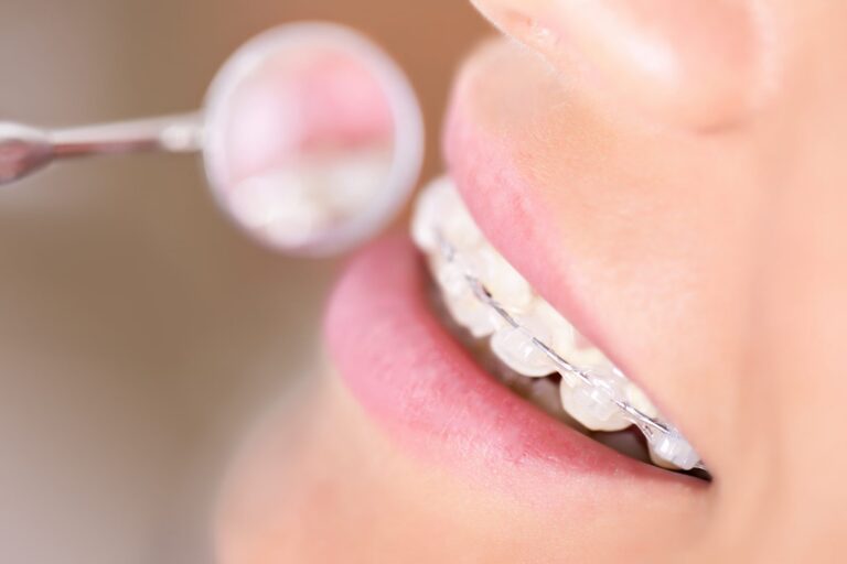 Close up of a woman with clear braces having her brackets examined with a dental mirror
