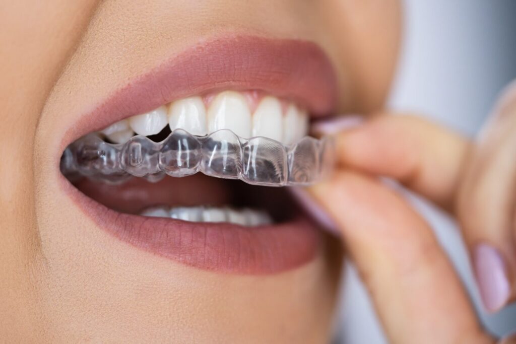 Woman placing her Invisalign® clear aligner into her mouth