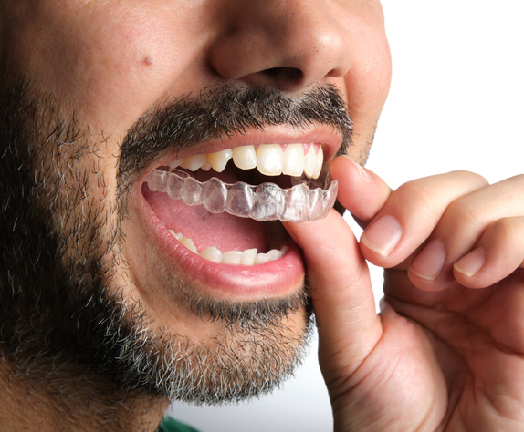 Close up of the mouth of a man with short salt and pepper beard inserting his top Invisalign aligner